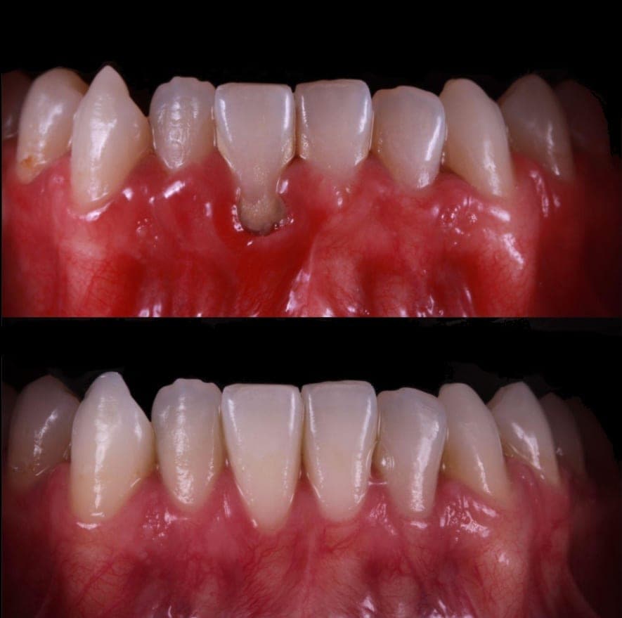 Contorno gingival y diseño de sonrisa. Transformación realizada con el método AM.