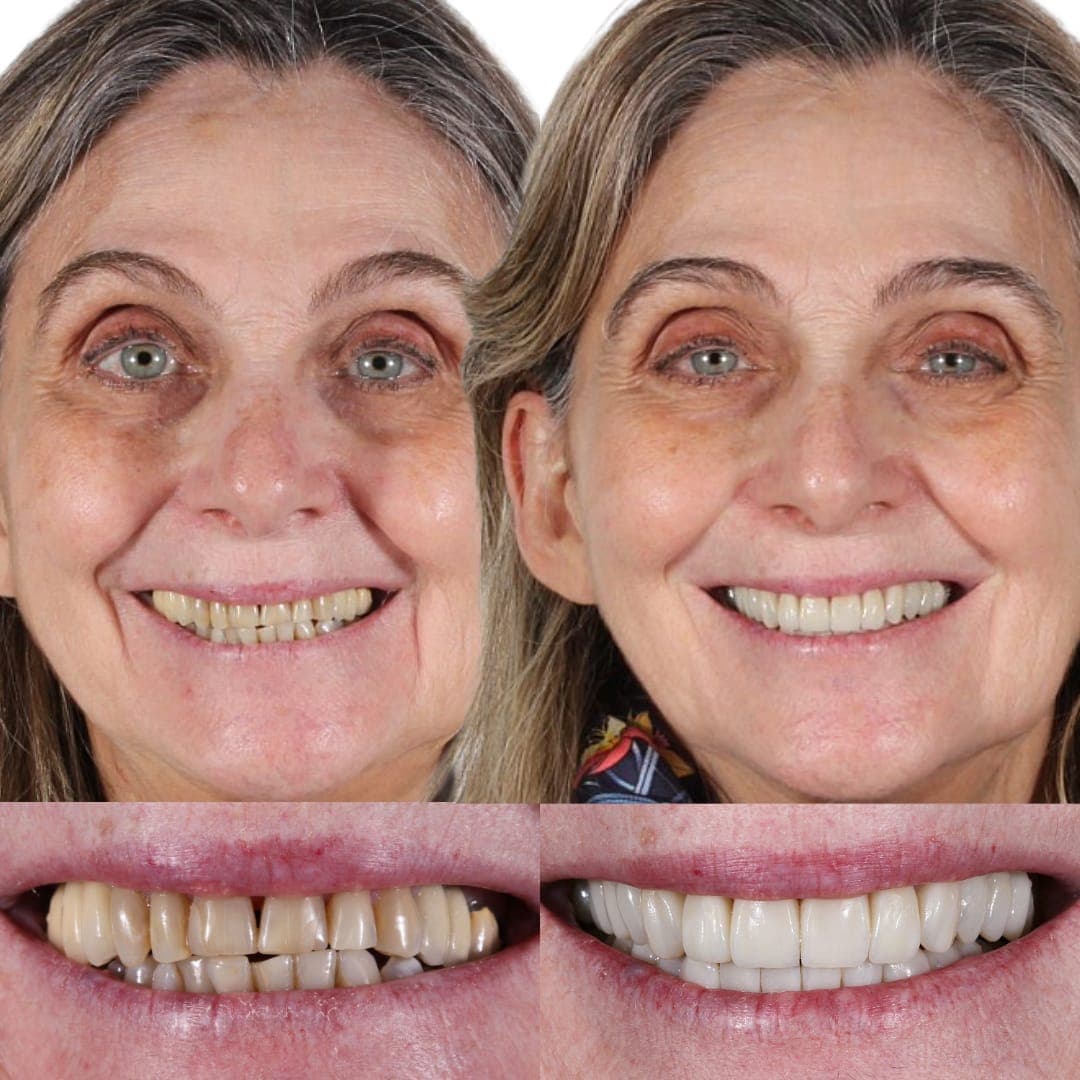 Renovó su sonrisa completa en menos de un mes. Transformación realizada con el método AM.